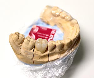 Serviços - Próstese Dentária